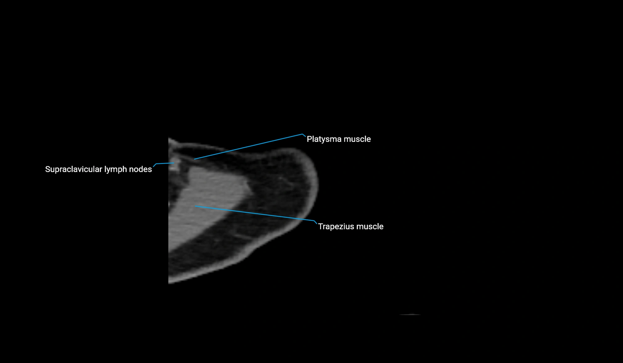 CT upper arm axial  cross sectional anatomy labelled radiology image -00040.webp